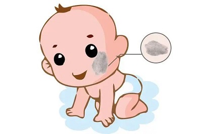 太田痣患者需要避免这些不科学的护理方式！