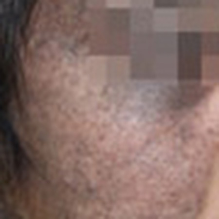 婴儿太田痣初期有哪些容易被忽略的症状？