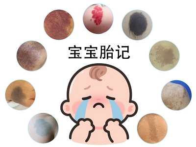 南京治疗医院：宝宝胎记多是什么原因造成的？